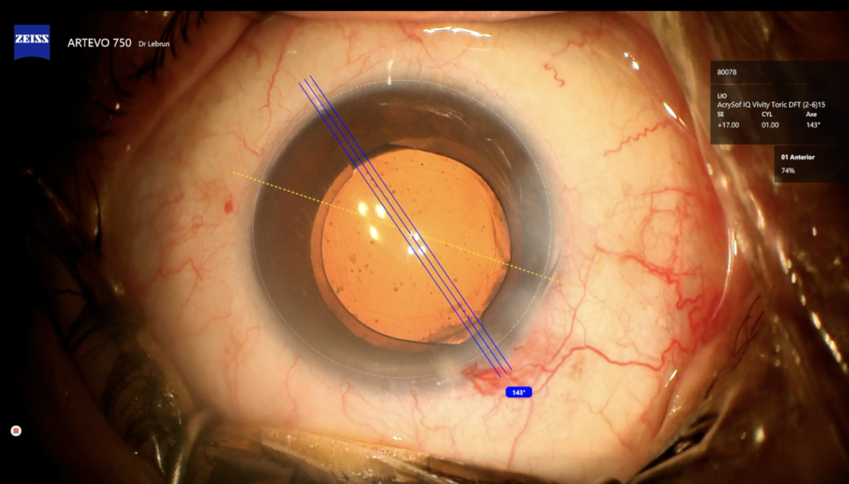 Vue peropératoire sur l'écran CALLISTO eye lors d'une pose d'implant